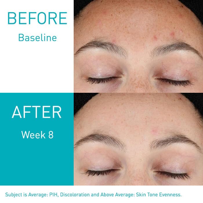 Retinol as skin anti-aging