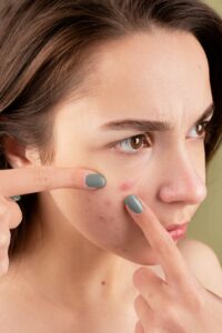 Natural-Acne-Treatment-for-Teens